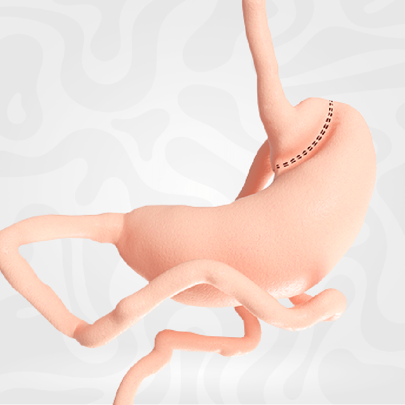 bypass-gastrico-perdida-peso-cirugia-estomago