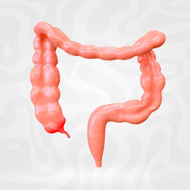 cirugia-apendicitis-extraccion-apendice-inflamado