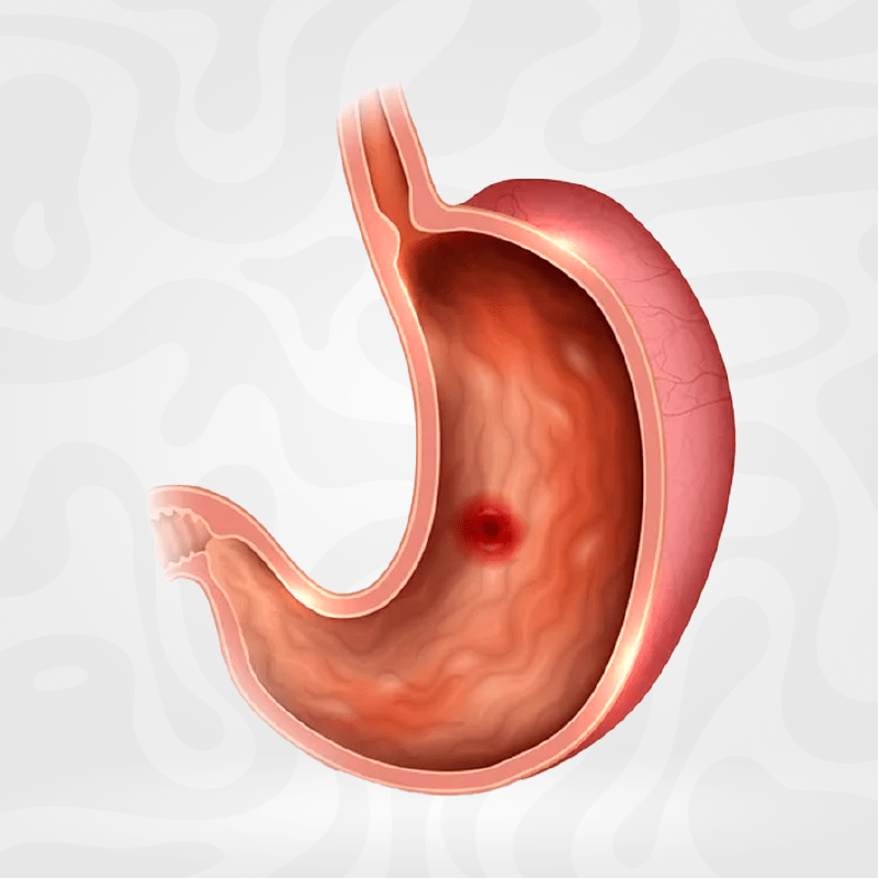 tratamiento-ulceras-gastricas-estomago