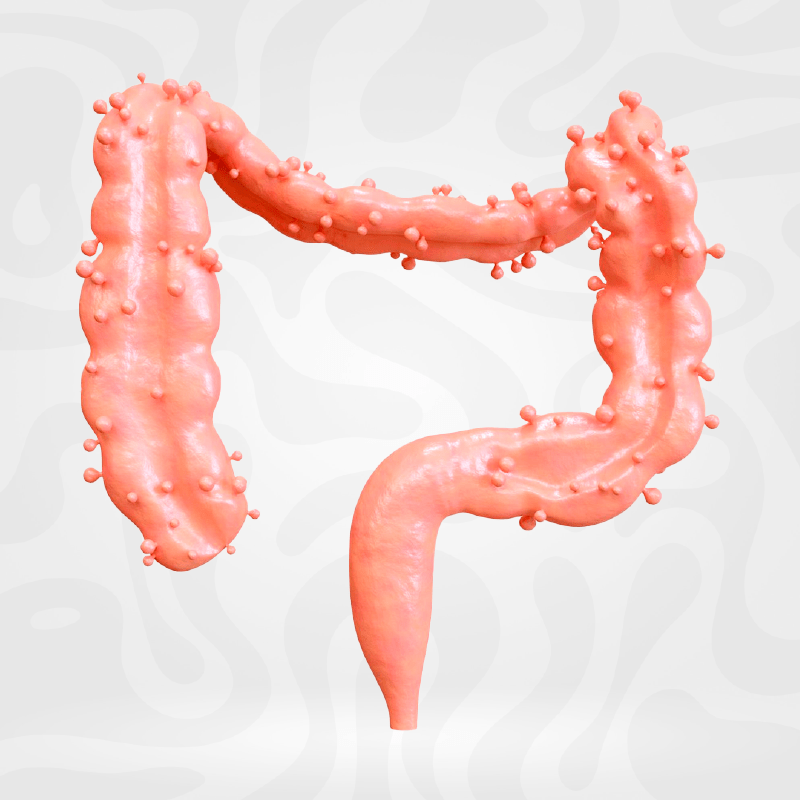 cirugia-diverticulos-colon-inflamado