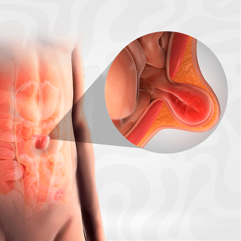 hernia-umbilical-cirugia-reparacion