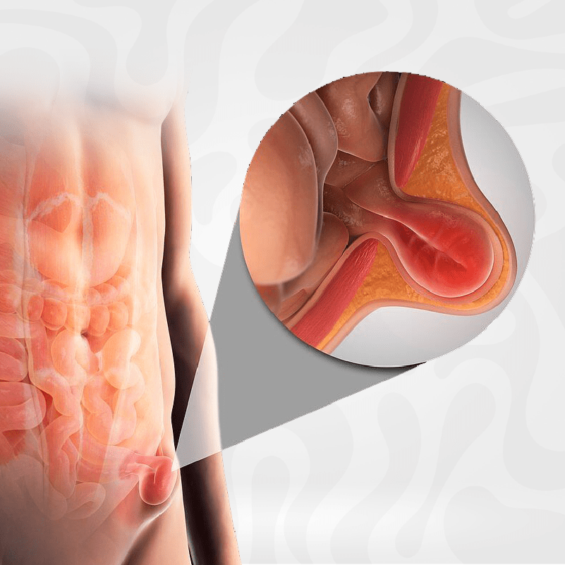 hernia-inguinal-cirugia-reparacion