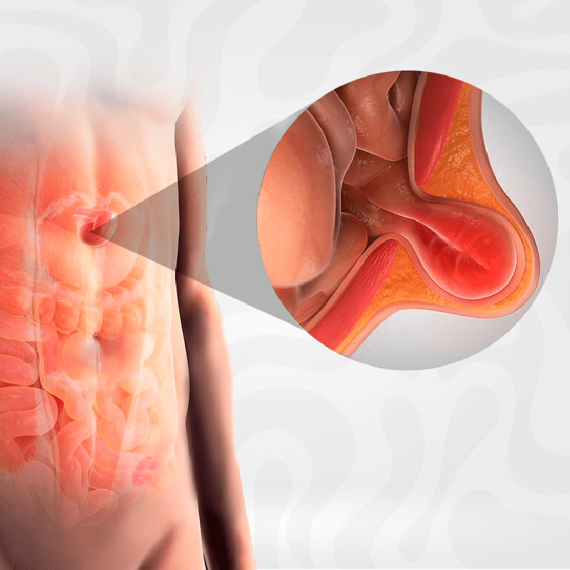 hernia-hiatal-tratamiento-reflujo
