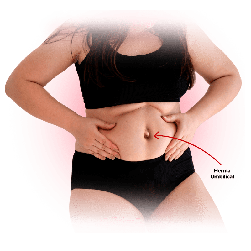 dr-javier-guevara-especialista-hernia-umbilical