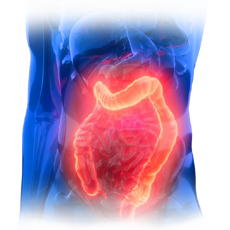 dr-javier-guevara-cirugia-diverticulos